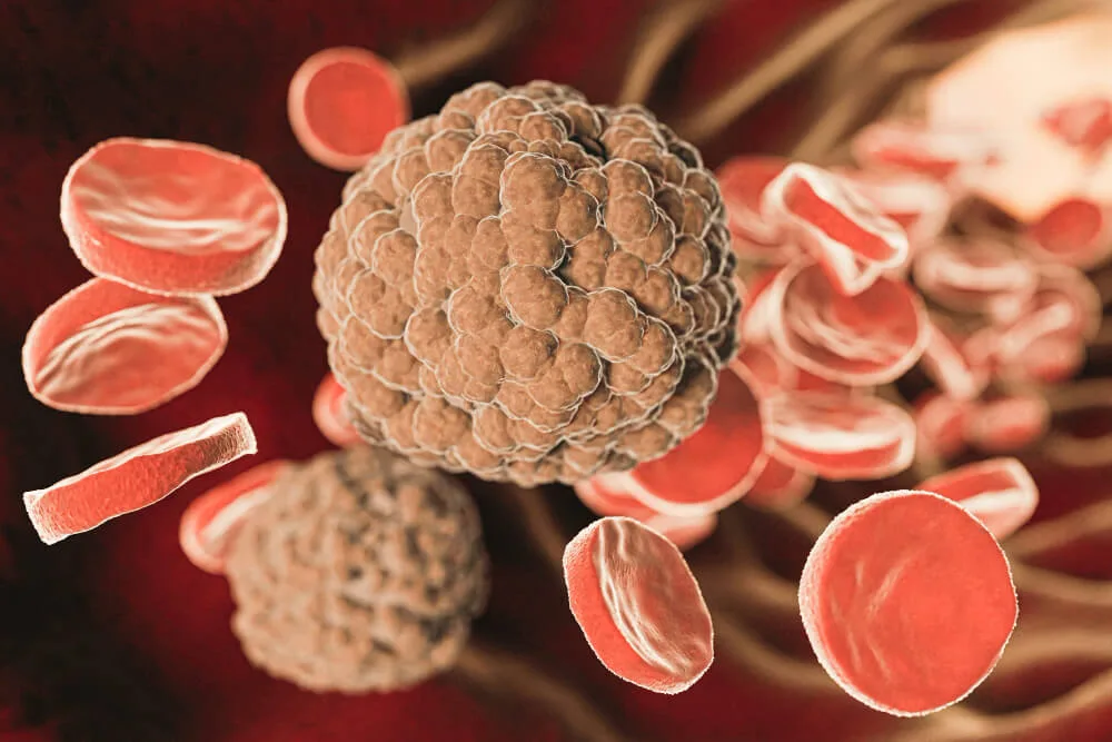 traitement stéatose hépatique non alcoolique efficace